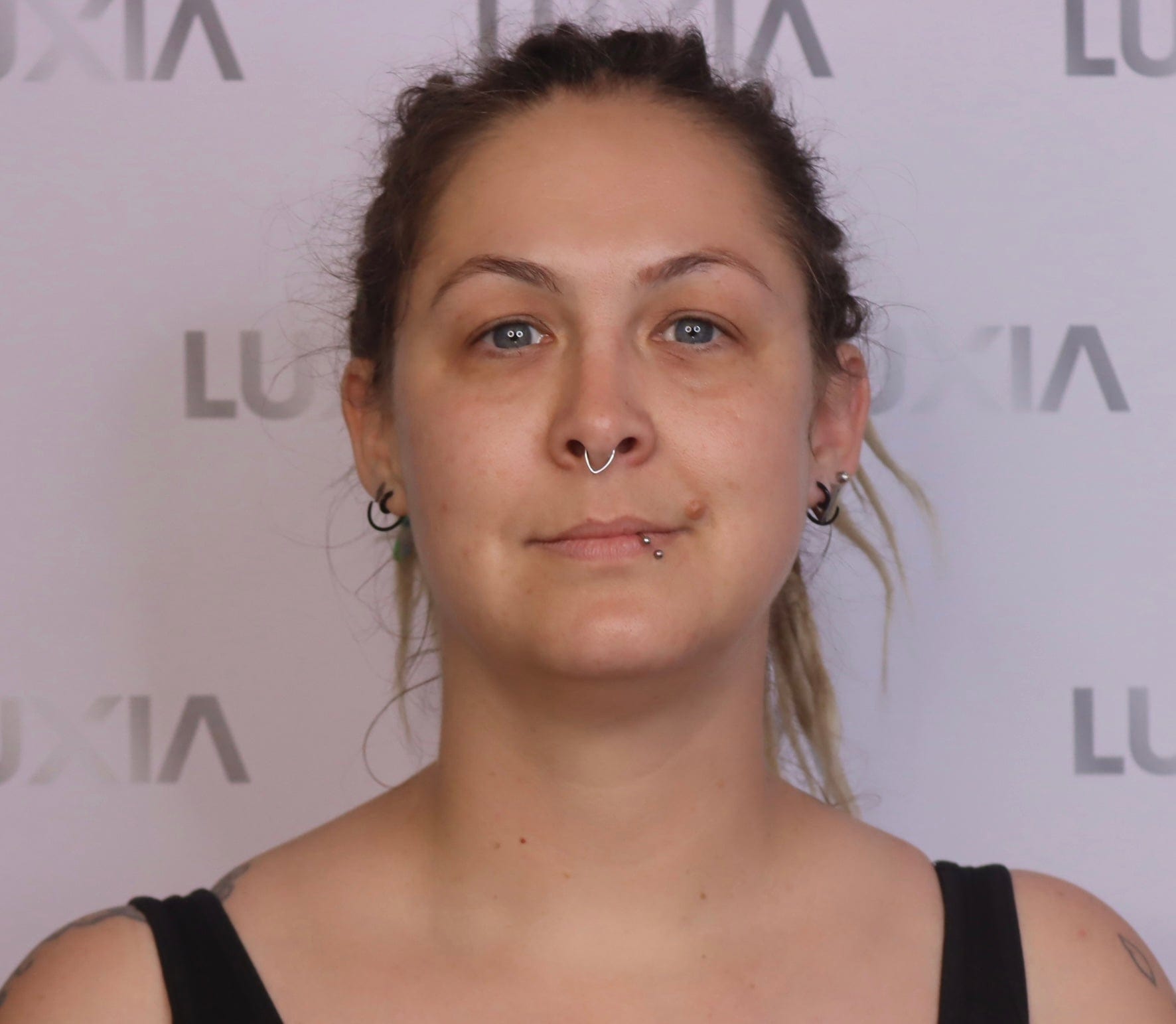 LUXIA Fat Dissolver 5 x 10ml - image of woman before using product